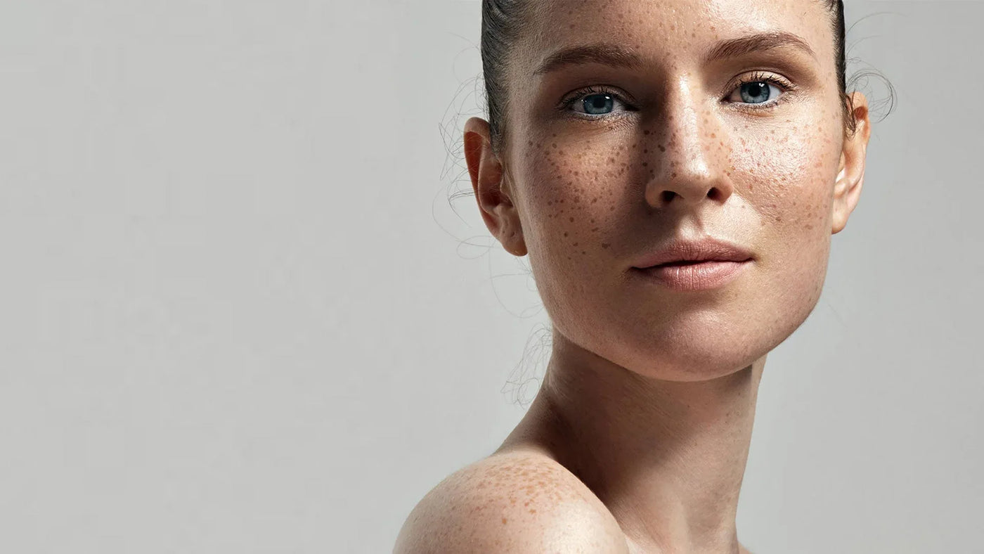 Manchas Hiper-Pigmentación - InternationalCosmetic