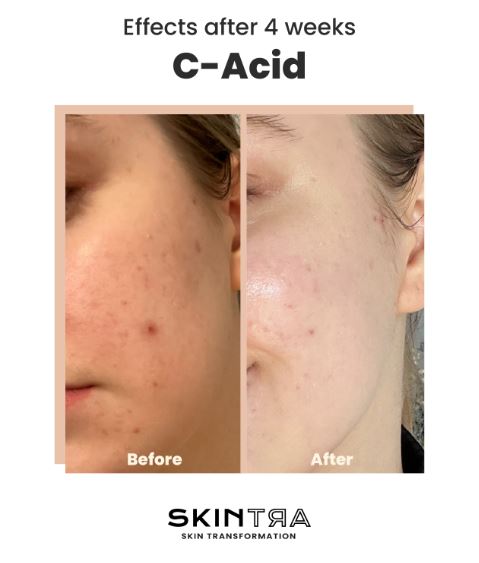 SKINTRA | C-Acid - 30ml