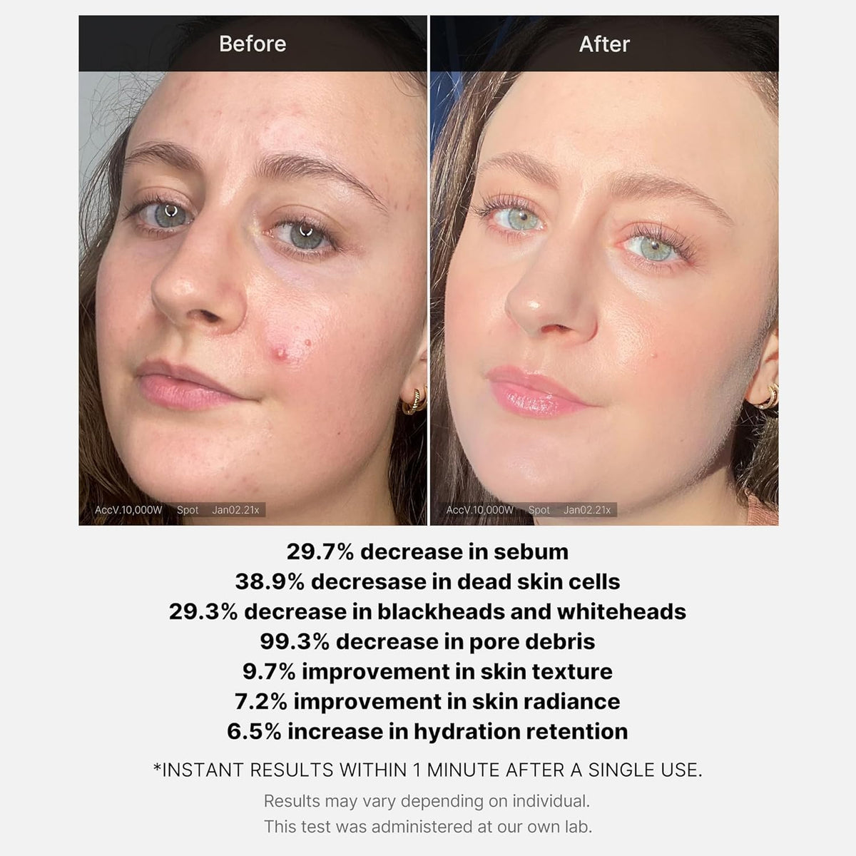 RED ACNE SUCCINIC ACID PEEL