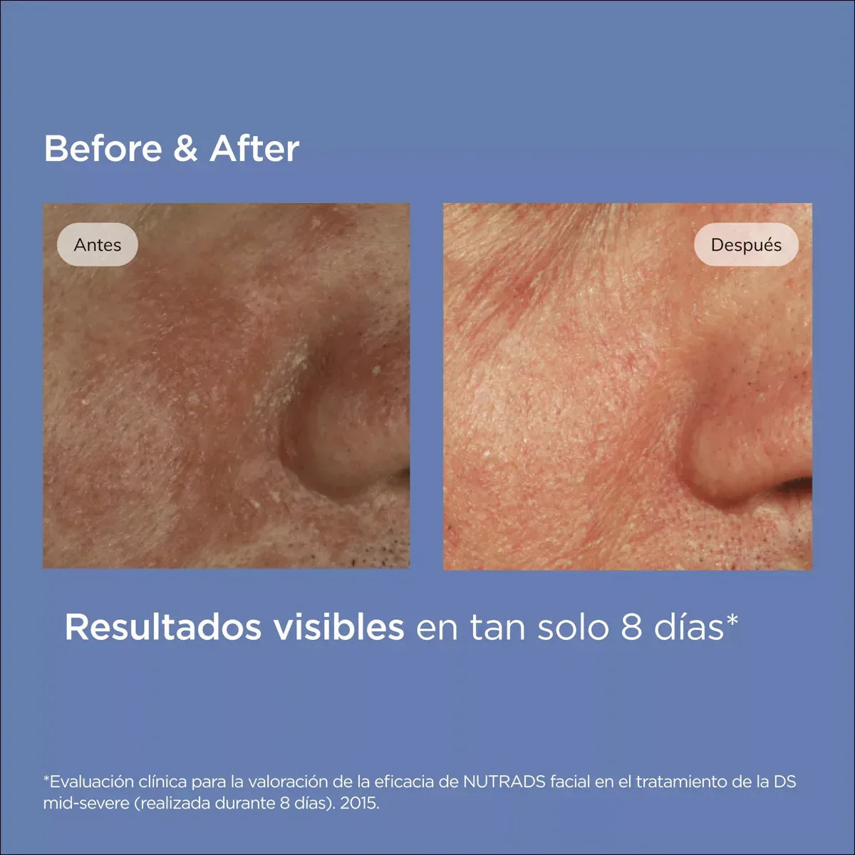 ISDIN | NUTRADEICA® Seborrheic Skin Facial Gel Cream - 50ml - InternationalCosmetic