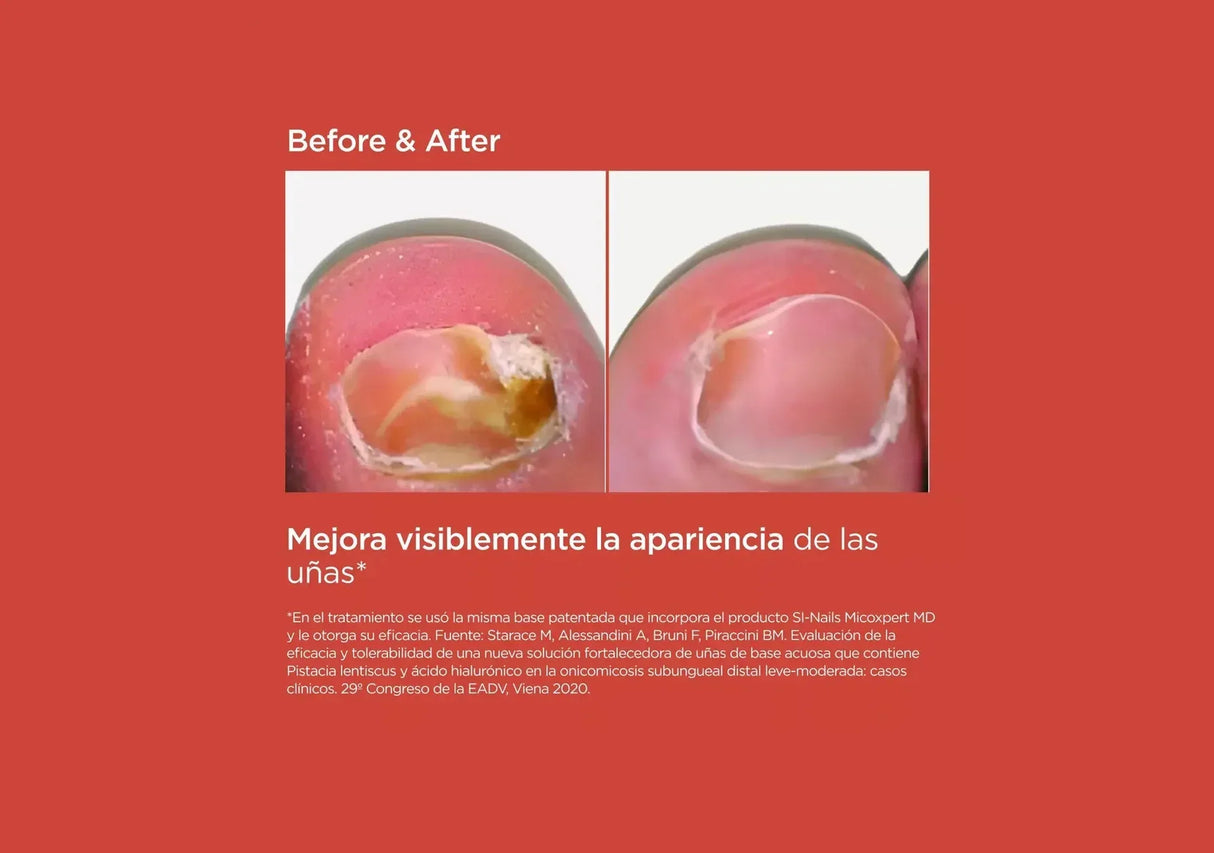 ISDIN | SI-NAILS® MicoXpert MD - 4.5ml - InternationalCosmetic