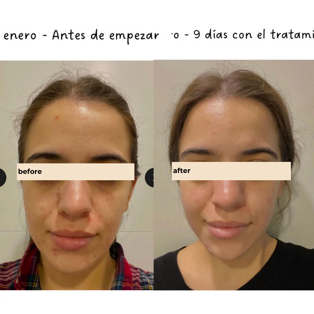 TWO POLES | Succinic Acid Salicylic Acid Blemish Control Treatment - 40ml