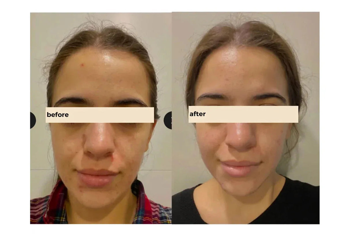 TWO POLES | Succinic Acid Salicylic Acid Blemish Control Treatment - 40ml - InternationalCosmetic