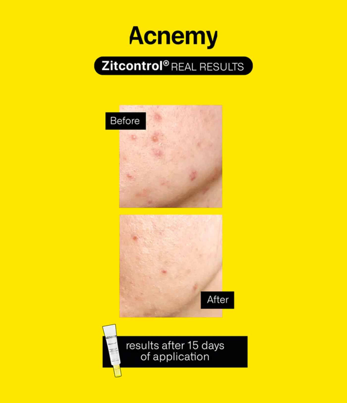 ACNEMY | Zitcontrol® - 40ml - InternationalCosmetic