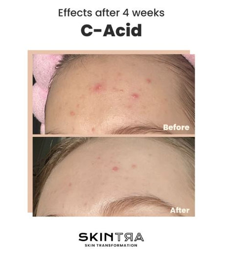 SKINTRA | C-Acid - 30ml