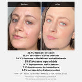 RED ACNE SUCCINIC ACID PEEL