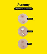 Dryzit® de Acnemy