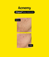 Zitpeel® de Acnemy